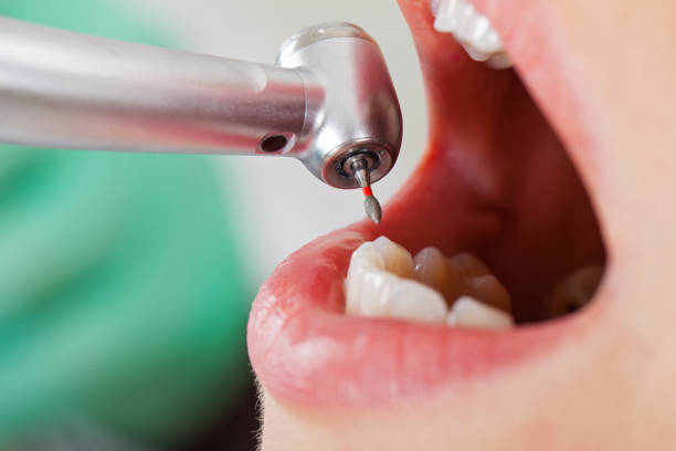 Best Knocked-Out Tooth (Avulsed Tooth) Treatment in Thomaston, GA